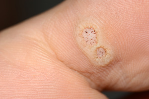 Foot Warts and Athlete’s Foot