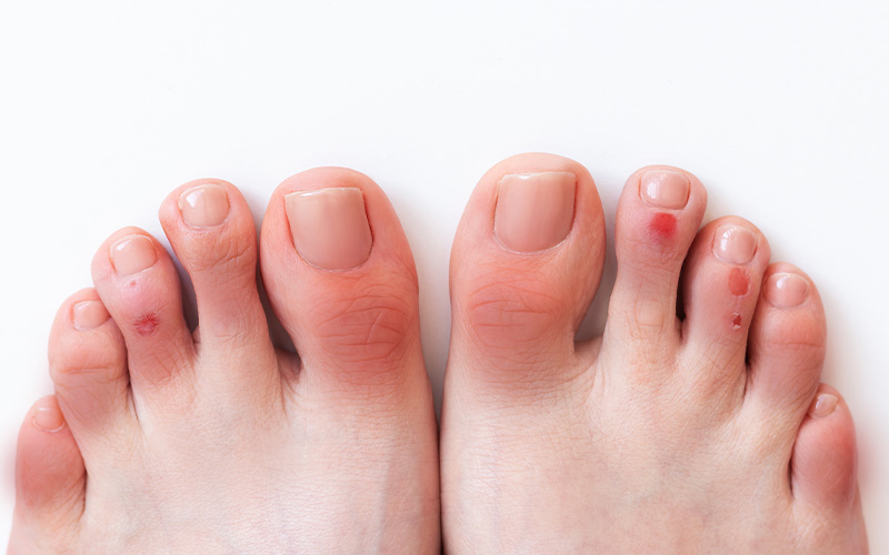 Red, inflamed toes and blisters from a nail salon infection