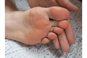 Corns and calluses developing on foot