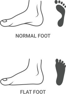 Flat foot compared to normal foot arch