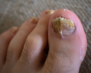 nail fungus affecting toenails