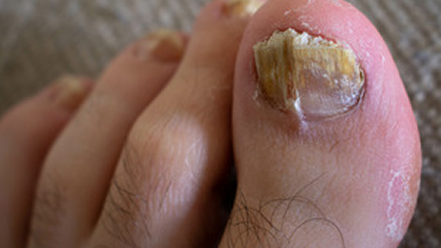 nail fungus affecting toenails