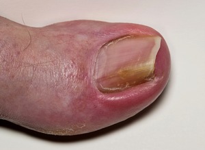 nail fungus infection causing toenail discolouration