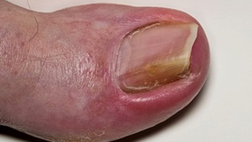 nail fungus infection causing toenail discolouration
