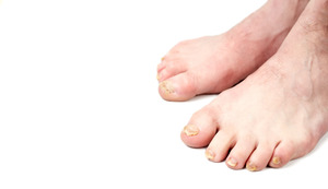 nail fungus treatment for patient's feet