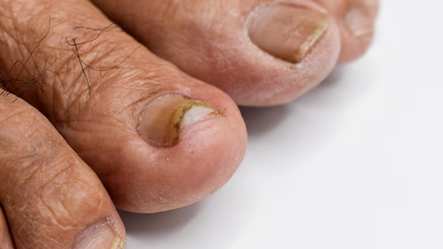 nail fungus treatment for patient's feet