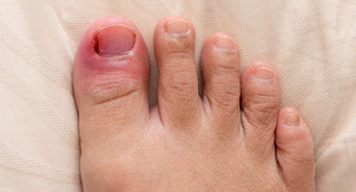 Causes and Risk Factors of an Ingrown Toenail