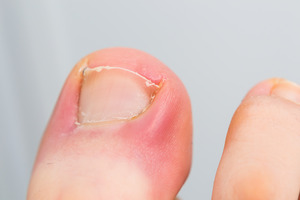 Symptoms of An Ingrown Toenail