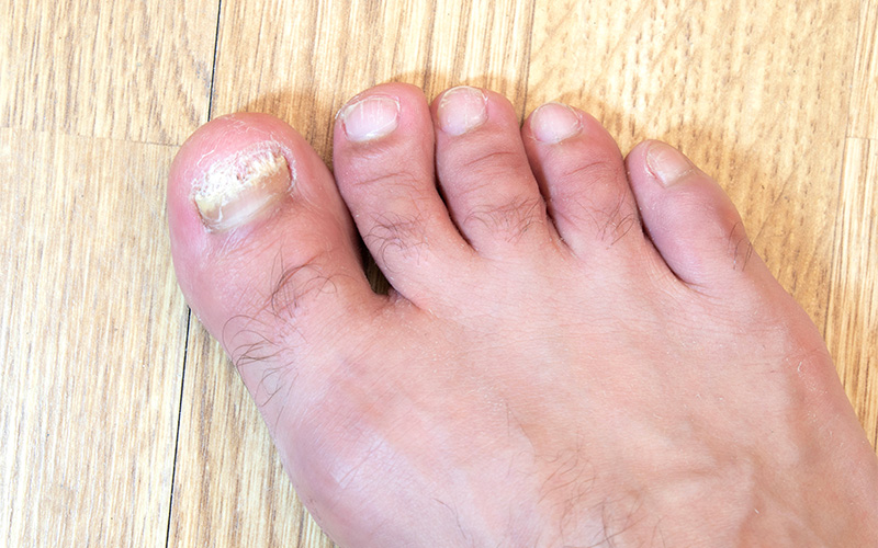 Discolored crumbly toenail showing signs of advanced fungus.