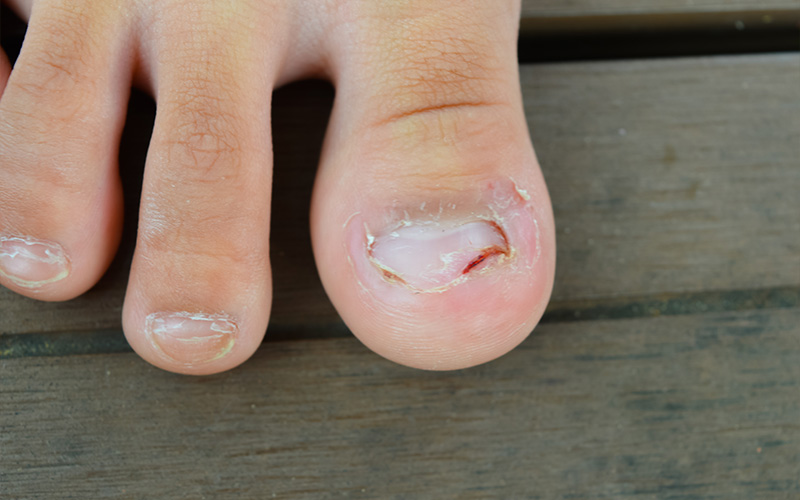 Ingrown Toenails Bleeding on the sides.
