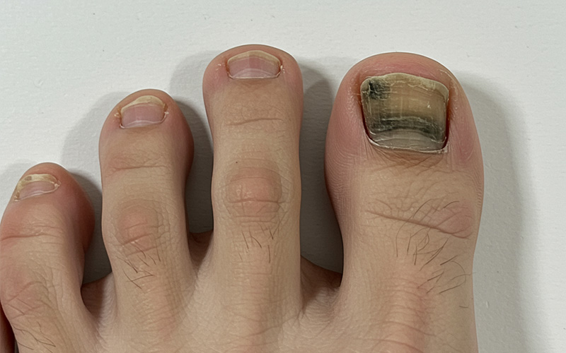 Pseudomonas infections on toenails