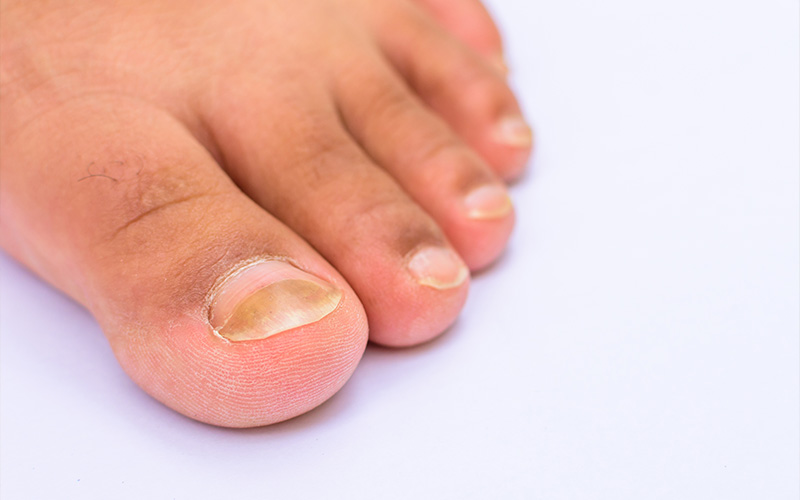 Thick, Discoloured Nails