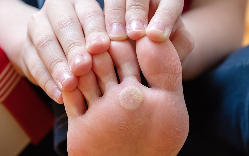 Foot with corn or callus needing treatment.