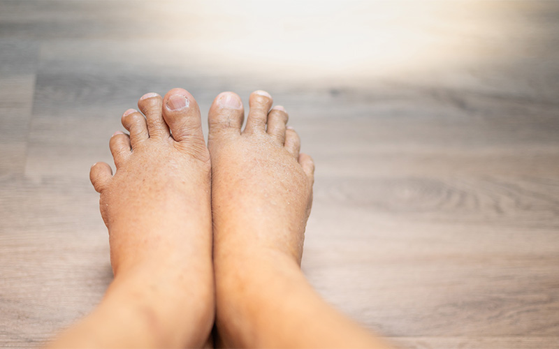 Swollen feet as a sign of fatigue or overexertion.